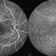 Cystoid Macular Edema (CME) Cystoid Macular Edema (CME)